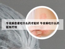 牛皮癣患者吃什么药才能好 牛皮癣吃什么药能有疗效