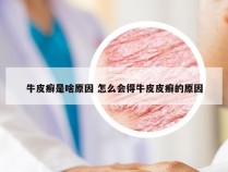 牛皮癣是啥原因 怎么会得牛皮皮癣的原因