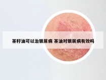 茶籽油可以治银屑病 茶油对银屑病有效吗