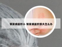 银屑病面积小 银屑病面积很大怎么办
