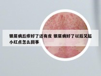 银屑病丘疹好了还有皮 银屑病好了以后又起小红点怎么回事