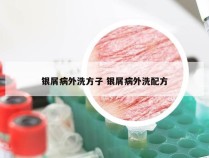 银屑病外洗方子 银屑病外洗配方