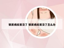 银屑病皮屑没了 银屑病皮屑没了怎么办