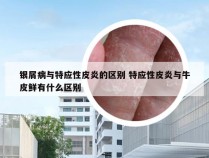 银屑病与特应性皮炎的区别 特应性皮炎与牛皮鲜有什么区别