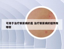 可用于治疗银屑病的是 治疗银屑病的植物有哪些