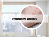 轻度银屑病蒽啉 银屑病轻型