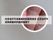北京治疗牛皮癣最好的医院排名 北京治疗牛皮肤癣最好的医院是哪个