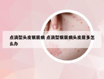 点滴型头皮银屑病 点滴型银屑病头皮屑多怎么办