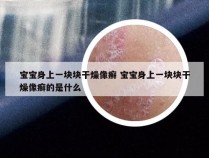 宝宝身上一块块干燥像癣 宝宝身上一块块干燥像癣的是什么