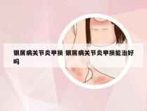 银屑病关节炎甲损 银屑病关节炎甲损能治好吗