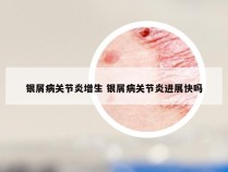 银屑病关节炎增生 银屑病关节炎进展快吗