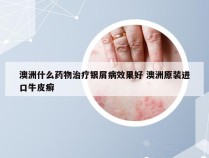 澳洲什么药物治疗银屑病效果好 澳洲原装进口牛皮癣