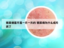 银屑病是不是一片一片的 银屑病为什么成片状了