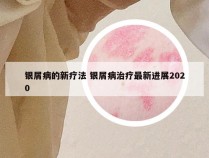 银屑病的新疗法 银屑病治疗最新进展2020