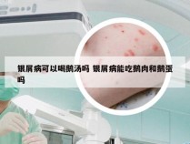 银屑病可以喝鹅汤吗 银屑病能吃鹅肉和鹅蛋吗