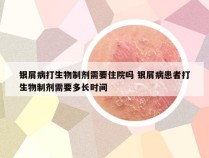 银屑病打生物制剂需要住院吗 银屑病患者打生物制剂需要多长时间