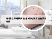 维a酸软膏对银屑病 维a酸对银屑病有没有效果