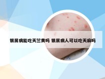 银屑病能吃天竺黄吗 银屑病人可以吃天麻吗