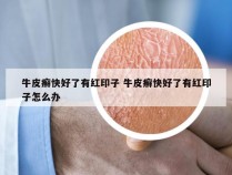 牛皮癣快好了有红印子 牛皮癣快好了有红印子怎么办