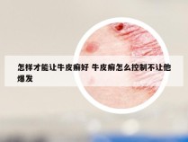 怎样才能让牛皮癣好 牛皮癣怎么控制不让他爆发