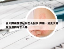 夏天脚踝皮肤起癣怎么回事 脚踝一到夏天就长水泡很痒怎么办