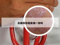 白癜风和银屑病一样吗