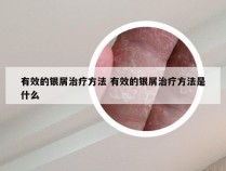有效的银屑治疗方法 有效的银屑治疗方法是什么