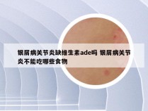 银屑病关节炎缺维生素ade吗 银屑病关节炎不能吃哪些食物