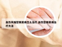 血热风燥型银屑病怎么治疗 血热型银屑病治疗方法