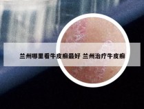 兰州哪里看牛皮癣最好 兰州治疗牛皮癣