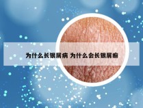 为什么长银屑病 为什么会长银屑癣