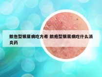 脓包型银屑病吃方希 脓疱型银屑病吃什么消炎药