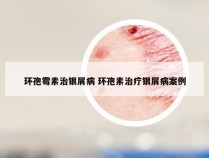 环孢霉素治银屑病 环孢素治疗银屑病案例