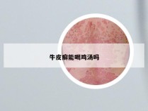 牛皮癣能喝鸡汤吗