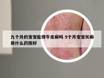 九个月的宝宝能得牛皮癣吗 9个月宝宝长癣用什么药擦好