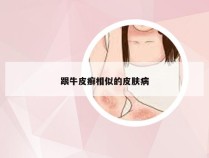 跟牛皮癣相似的皮肤病