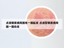 点滴银屑病周围有一圈起皮 点滴型银屑病周围一圈白皮