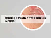 银屑病用什么野草可以治好 银屑病用什么草药泡水喝好