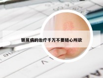 银屑病的治疗千万不要随心所欲