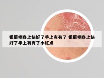 银屑病身上快好了手上有有了 银屑病身上快好了手上有有了小红点