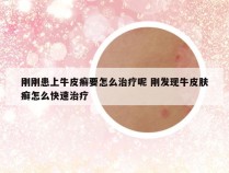 刚刚患上牛皮癣要怎么治疗呢 刚发现牛皮肤癣怎么快速治疗