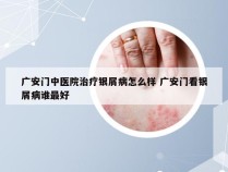 广安门中医院治疗银屑病怎么样 广安门看银屑病谁最好