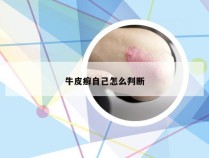牛皮癣自己怎么判断