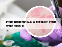 长期打生物制剂的后果 强直性脊柱炎长期打生物制剂的后果