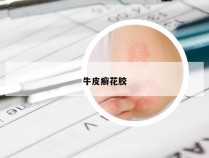 牛皮癣花胶