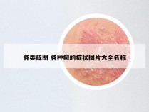 各类藓图 各种癣的症状图片大全名称