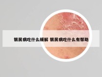 银屑病吃什么缓解 银屑病吃什么有帮助