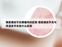 银屑病关节炎跟痛风的区别 银屑病关节炎与风湿关节炎有什么区别
