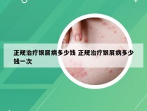 正规治疗银屑病多少钱 正规治疗银屑病多少钱一次