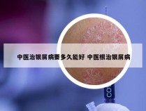 中医治银屑病要多久能好 中医根治银屑病